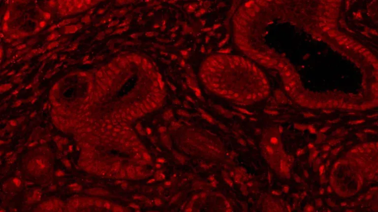 MYC-in-pancreatic-biopsy_UCSF Press Release image
