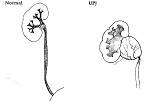 Ureteropelvic Junction Obstruction illustration